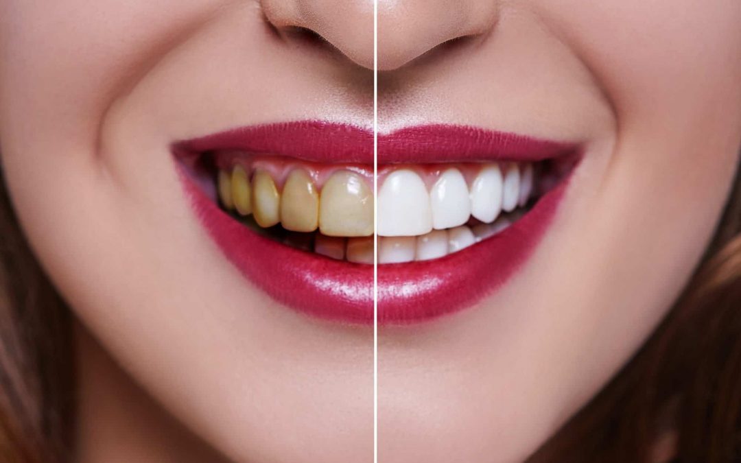Before and After of Popular Cosmetics Dentistry