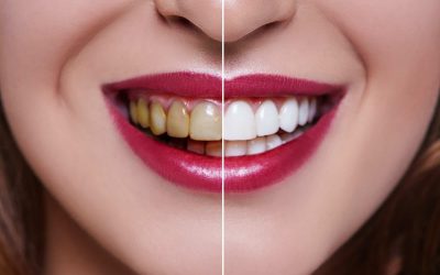 Before and After of Popular Cosmetics Dentistry