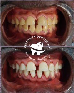 Celebrity Dentist NG - Scaling & Polishing with Laser Teeth Whitening