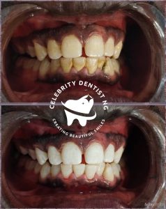 SP n Teeth Whitening11