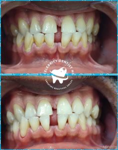 SP n Teeth Whitening2