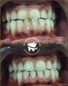 Celebrity Dentist NG - Deep Cleaning & Advanced Laser Teeth Whitening