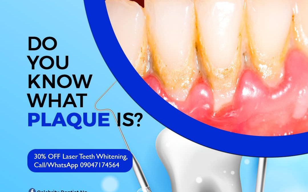 Removing Plaque, Calculus, and Stains