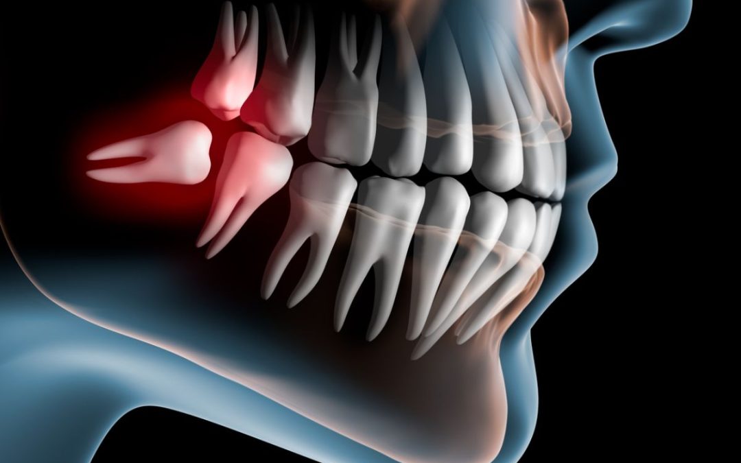 Wisdom Teeth: Understanding Their Role and Treatment Options