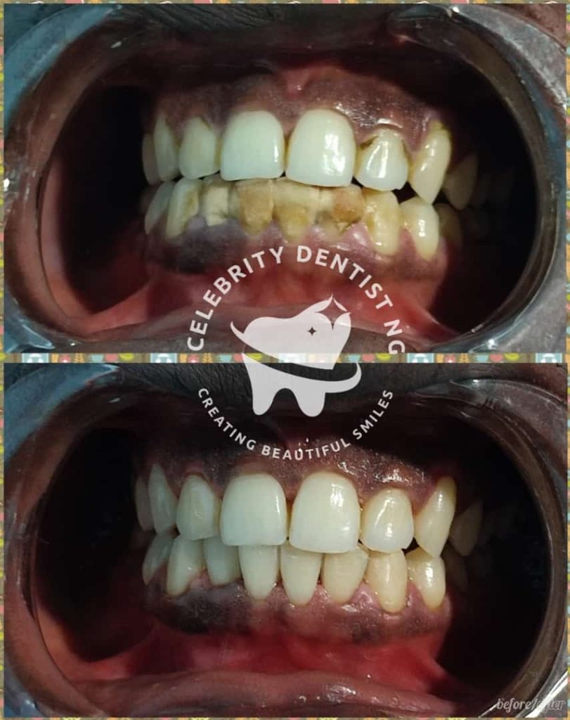Celebrity Dentist scaling & polishing before and after