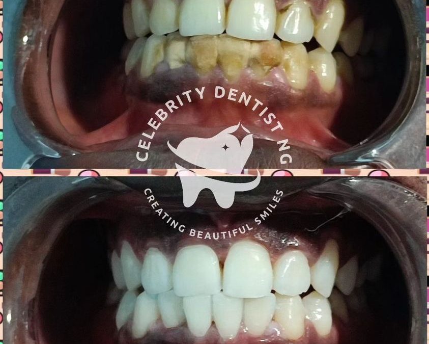 Scaling & Polishing vs Teeth Whitening: Understanding the Differences for a Dazzling Smile