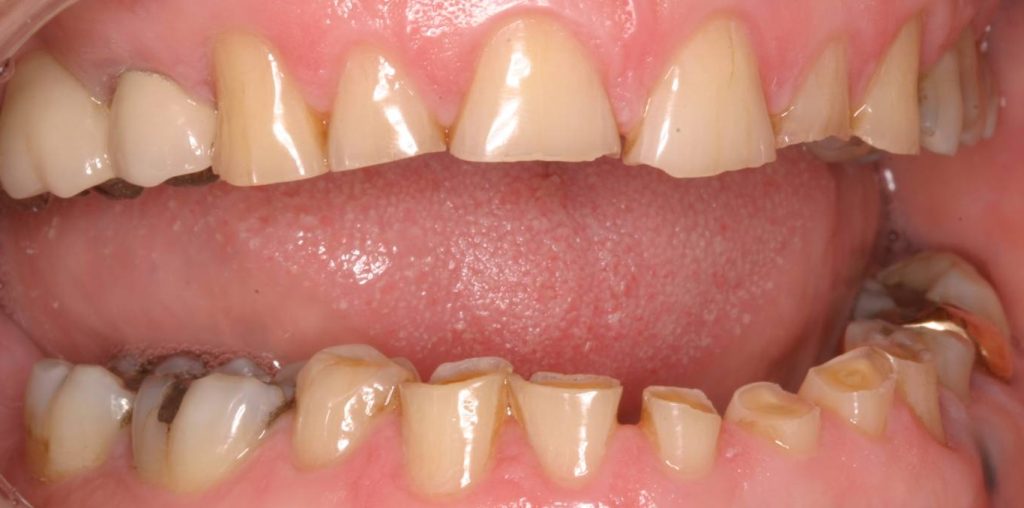 Celebrity Dentist NG - Teeth wear - bruxism