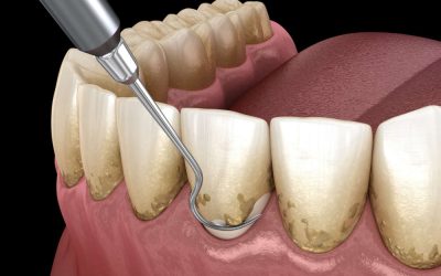 The Hidden Dangers of Plaque: Why Regular Teeth Cleaning Is a Must!