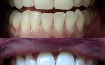 How Laser Teeth Whitening Works: The Science Behind a Brighter Smile